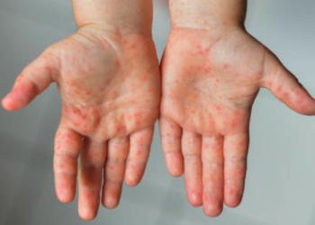 Casi 40 millones de niños en riesgo por el sarampión