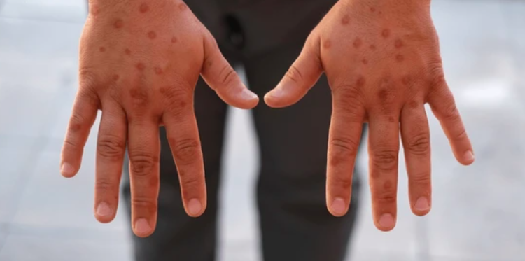 Mpox: Lo que hay que saber sobre esta emergencia mundial de salud pública