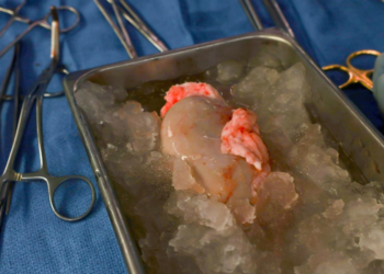 Realizan tercer trasplante en la historia de riñón de cerdo a humano